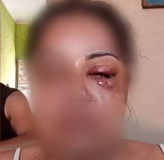 Vítima com olho machucado após ser agredida com socos e chutes (Foto: Direto das Ruas)