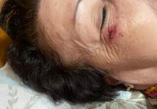 Machucado no rosto de senhora que caiu em escada rolante (Foto: Direto das Ruas)