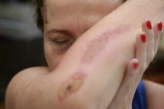 Mulher exibe hematomas e ferimentos (Foto: Campo Grande News/Arquivo)