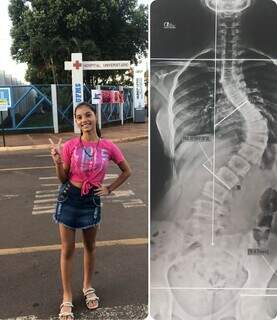 A la izquierda, un adolescente de 13 años con escoliosis.  A la derecha, una radiografía de la columna afectada (Foto: Archivo Personal)