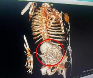 Feto mumificado no abdômen de paciente do Hospital Regional de Ponta Porã (MS) (Foto: Tomografia/Reprodução)