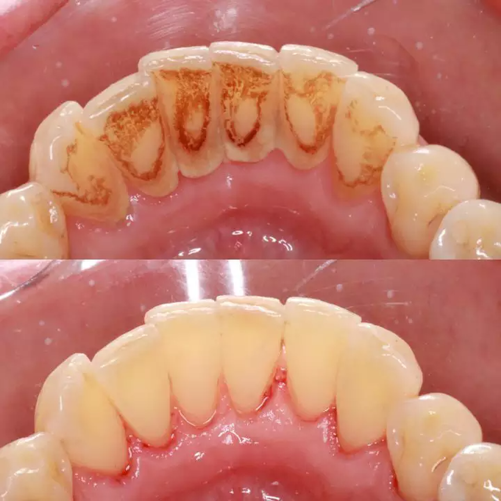 Cuidado com o tártaro nos dentes, ele pode afetar sua saúde cardíaca ...