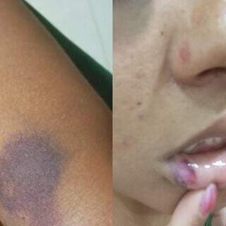 Ferimentos no braço e no rosto da mulher, deixados pelas últimas agressões sofridas (Fotos: Arquivo pessoal)