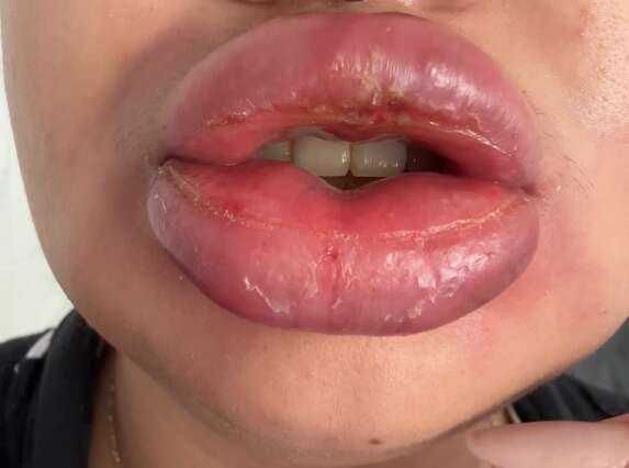 Nutricionista vai pagar R$ 35 mil para retirar preenchedor sintético dos lábios