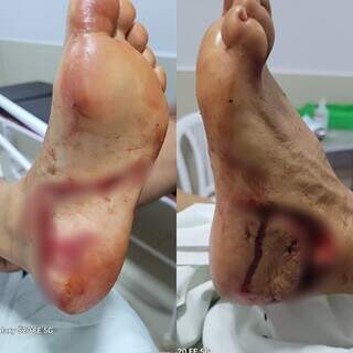 Mulher teve corte profundo no pé após levar mordida de peixe dourado (Foto: Divulgação)