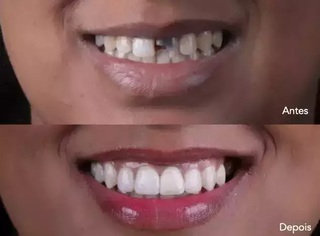 Antes e depois do implante dentário mostra diferença incrível. (Foto: Divulgação)