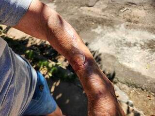 Braço de idosa atacada pelo galo (Foto: Geniffer Valeriano)