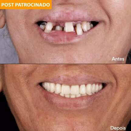 Implante dentário sem dor acaba com sofrimento e devolve seu sorriso