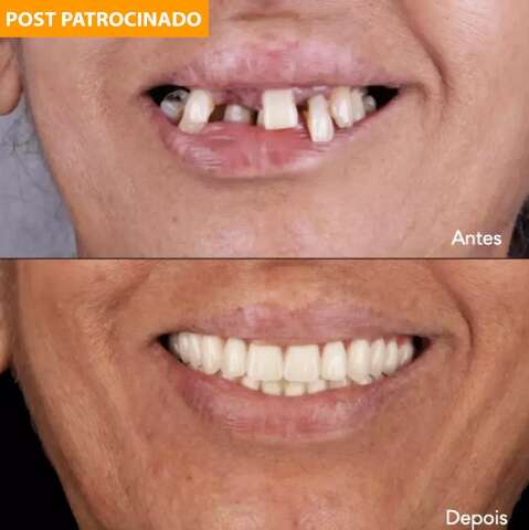 Implante dentário sem dor acaba com sofrimento e devolve seu sorriso