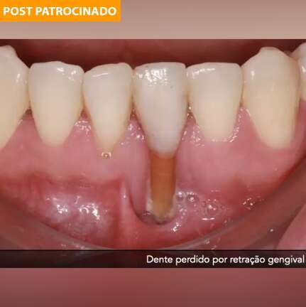 Sensibilidade dentária pode ser sinal até de perda dos dentes