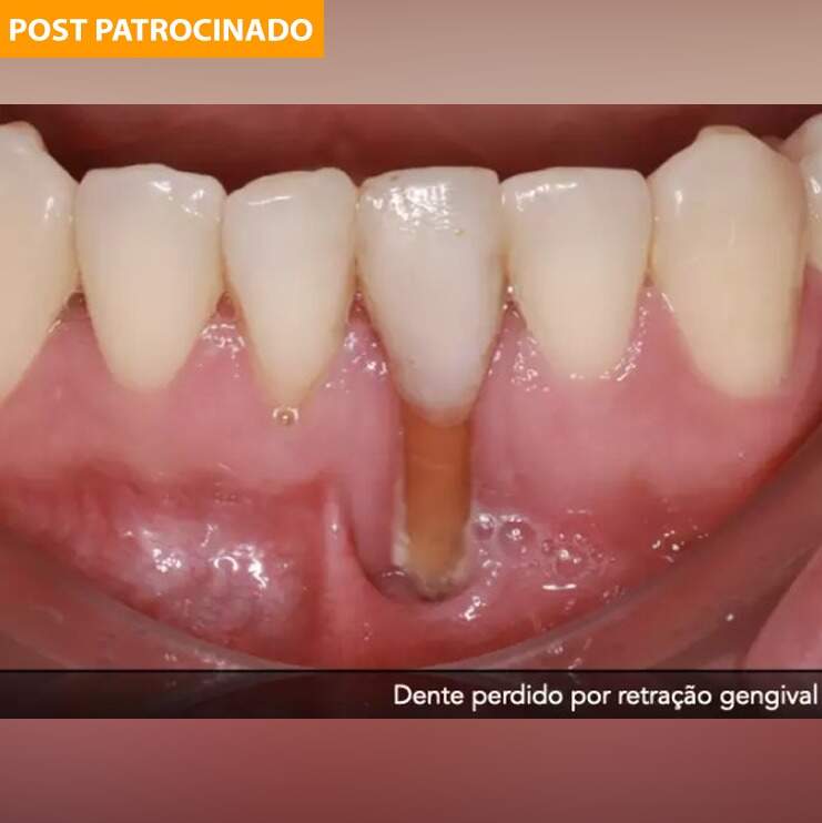 Sensibilidade dentária pode ser sinal até de perda dos dentes