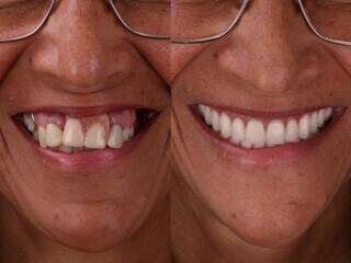 Tratamento garantiu o sorriso que paciente tanto sonhava. (Foto: Divulgação)