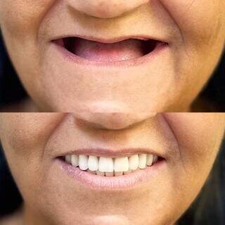 Antes e Depois de um sorriso e autoestima renovados. (Foto: Marketing Odontoclinic)