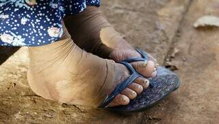 Com feridas infeccionadas, dona Maria teme ter que parar o tratamento por falta de recursos (Foto: Campo Grande News/Alex Machado)