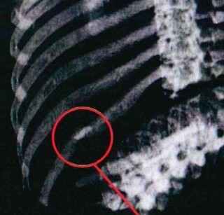 Raio-x mostra costela de vítima fraturada (Foto: Reprodução)