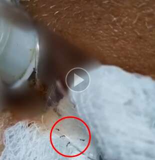 Família vê formigas em traqueostomia e denuncia hospital por maus-tratos