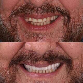 Imagem mostra o antes e depois do paciente que conseguiu recuperar a vontade de sorrir. (Foto: Divulgação)