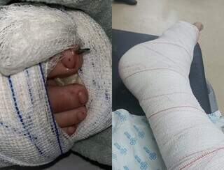 Do lado esquerdo, o pé da criança após a cirurgia com colocação de pino; enquanto pai aguardo o procedimento (Foto: arquivo pessoal)