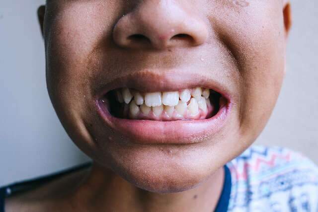 Por que as pessoas nascem com os dentes tortos?