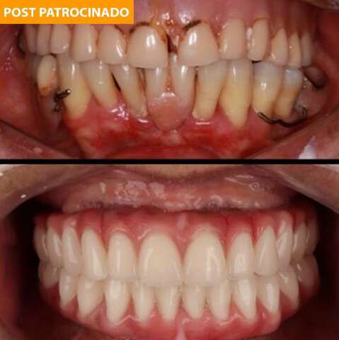 Dentadura ou prótese fixa: qual a melhor opção quando há perda dos dentes?