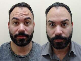 Antes e depois do botox. (Foto: Divulgação)