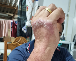 Trabalhador mostra mão machucada após sofrer acidente de trabalho em frigorífico (Foto: Divulgação)