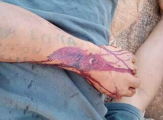 Indígena ferido após ataque sofrido neste sábado (3) em Douradina (Foto: Abip)