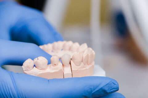 Tudo o que voc&ecirc; precisa saber sobre implantes dent&aacute;rios