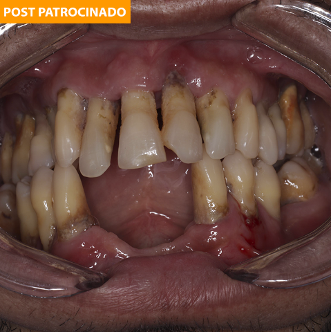 Doença do tártaro: inflamação pode levar até à perda dos dentes