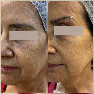 O fox eyes com botox é um tratamento que promove o arqueamento das sobrancelhas e “abre” o olhar