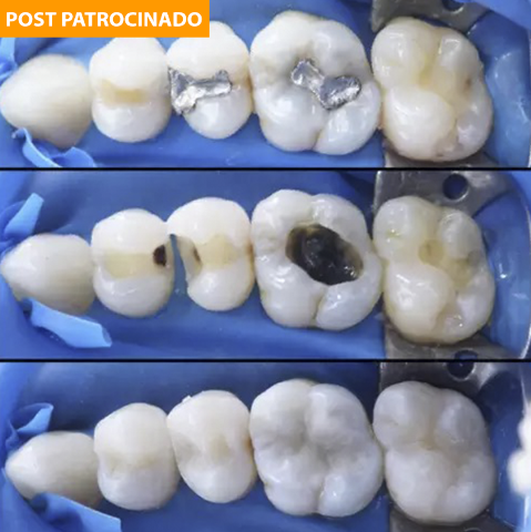 Cárie não é brincadeira e pode levar à perda dos dentes, saiba como