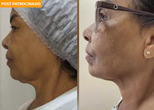 Royal Face celebra aniversário com botox que cabe no seu bolso