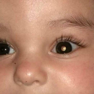 Criança com reflexo branco no olho, um dos sinais do retinoblastoma (Foto: Reprodução)