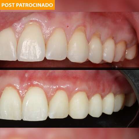 Está com sensibilidade? Cuidado, recessão gengival pode levar à perda dos dentes