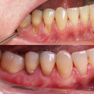 Est&aacute; com sensibilidade? Cuidado, recess&atilde;o gengival pode levar &agrave; perda dos dentes