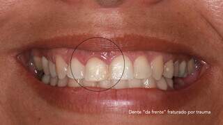 Dente frontal havia sido fraturado. (Foto: Divulgação)