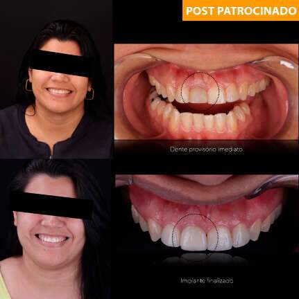 Perdeu o dente? Não sofra e saia do consultório sorrindo no mesmo dia