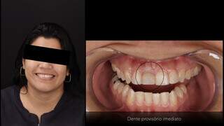 Paciente recebeu o implante temporário para não sofrer sem o dente. (Foto: Divulgação)