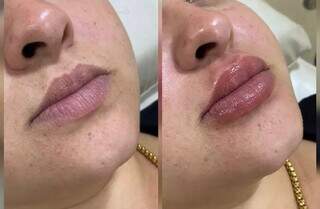 Preenchimento labial traz volume, simetria e promove hidratação. (Foto: Divulgação)