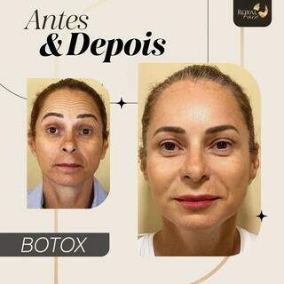 Botox trata linha de expressão e devolve jovialidade. (Foto: Divulgação)