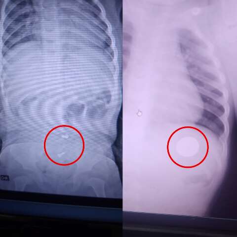 Diagnosticado com pneumonia, beb&ecirc; tinha moeda e parafusos no est&ocirc;mago