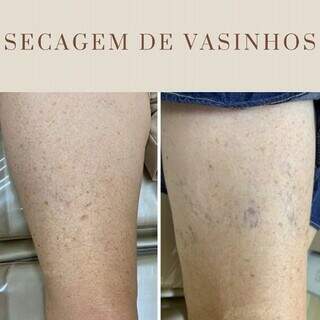 Secagem poderosa: Reduza os &lsquo;vasinhos&rsquo; e brilhe com a Royal Face