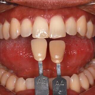 Quer um sorriso incr&iacute;vel? Veja como o clareamento deixa seus dentes mais brancos