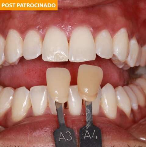 Quer um sorriso incrível? Veja como o clareamento deixa seus dentes mais brancos