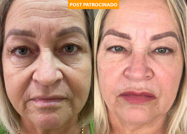 Rejuvenesça a tempo de curtir a folia com o bioestimulador da Royal Face