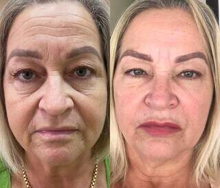 Rejuvenes&ccedil;a a tempo de curtir a folia com o bioestimulador da Royal Face