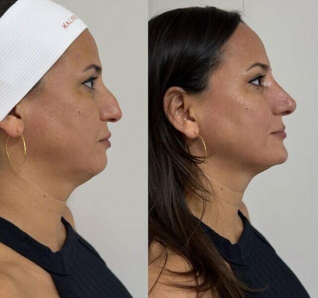 Com método próprio, Haline é referência em Harmonização Facial em Corumbá 10 1lezs6skgcpsk haline