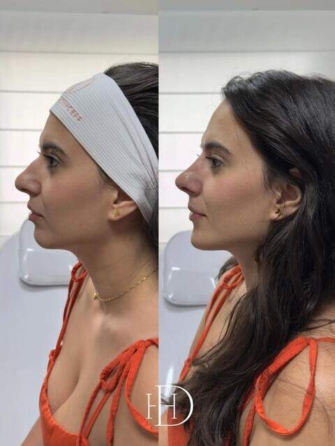 Com método próprio, Haline é referência em Harmonização Facial em Corumbá 3 2imr40yoi22og haline