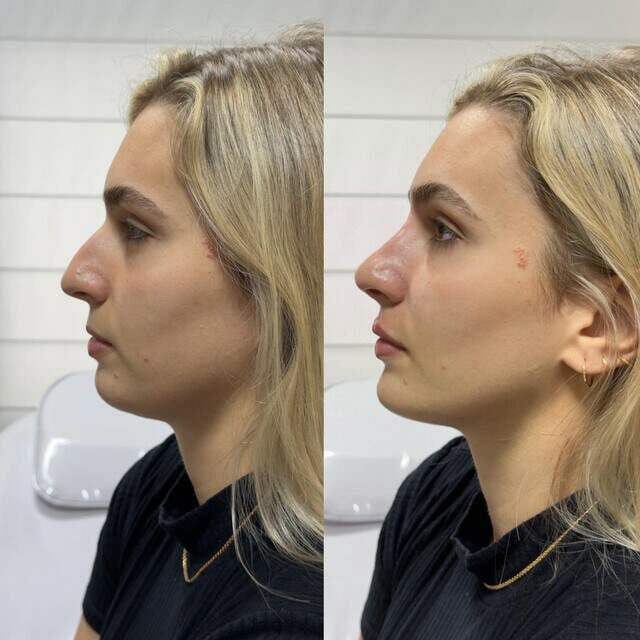 Com método próprio, Haline é referência em Harmonização Facial em Corumbá 4 haline Darmanceff é referência