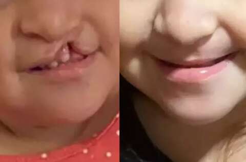 &quot;&Eacute; um al&iacute;vio&quot;, comemora m&atilde;e sobre lei que garante tratamento de fenda palatina 